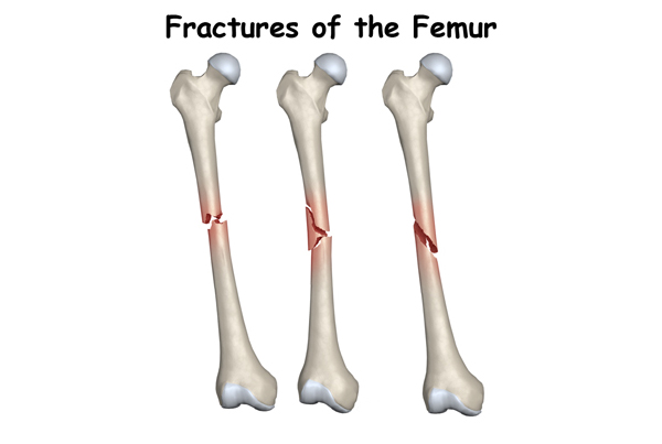 Adult Lower Leg Fractures