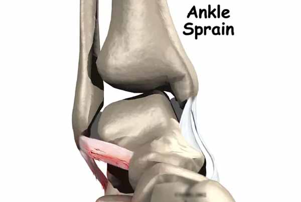 Ankle Sprain and Instability