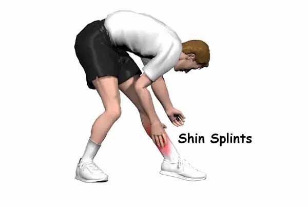 Shin Splints