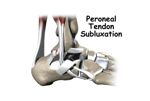 Peroneal Tendon Subluxation