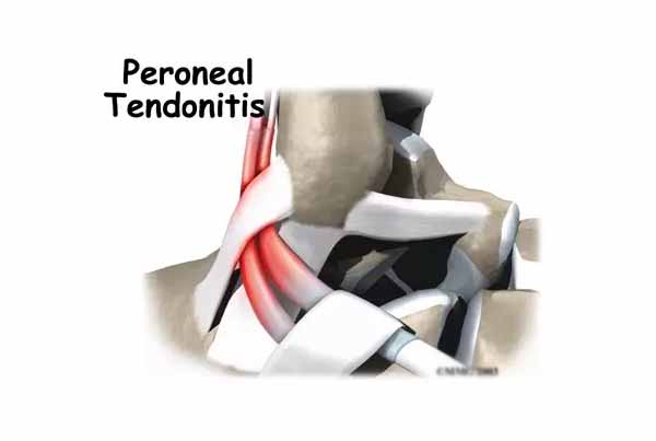 Peroneal Tendon Problems