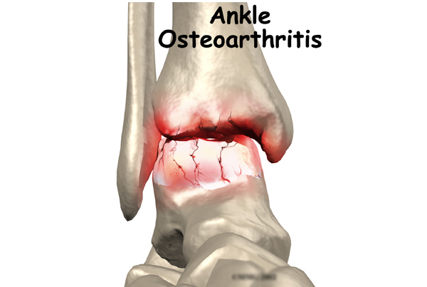 Osteoarthritis of the Ankle