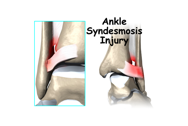 Ankle Syndesmosis Injuries