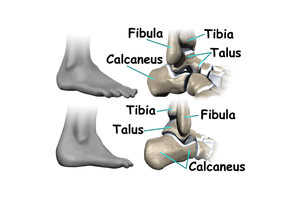 Ankle Impingement Problems
