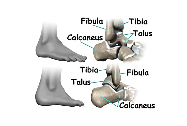 Ankle Issues