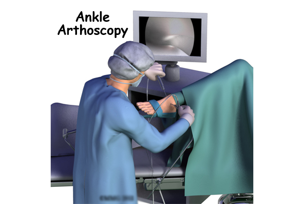 Ankle Arthroscopy