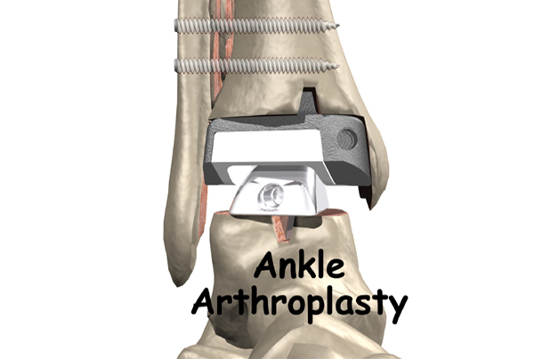 Artificial Joint Replacement of the Ankle