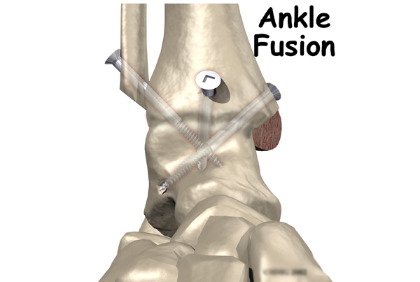 Ankle Fusion