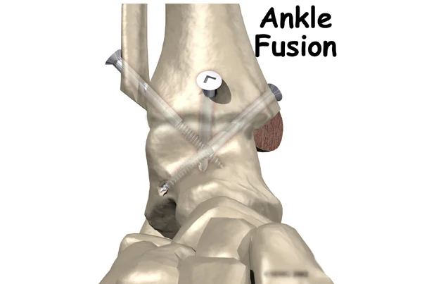 Ankle Surgery