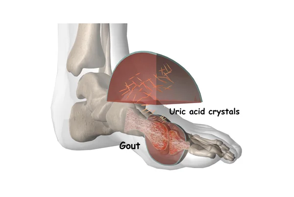 Gout