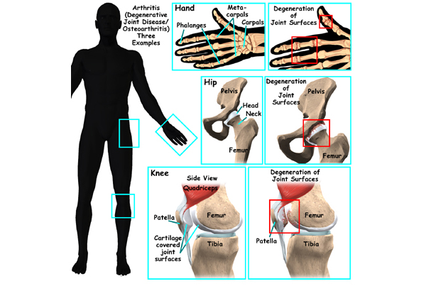  Arthritis