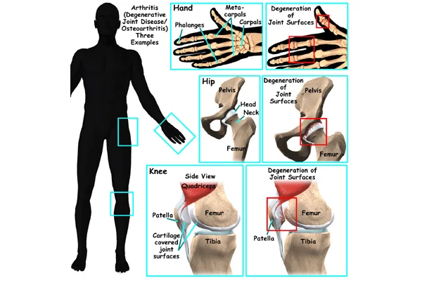  Arthritis