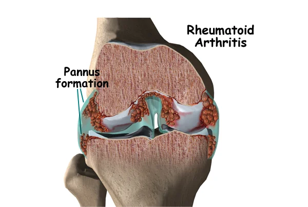 Rheumatoid Arthritis