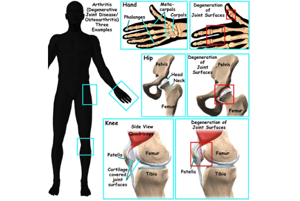 Osteoarthritis