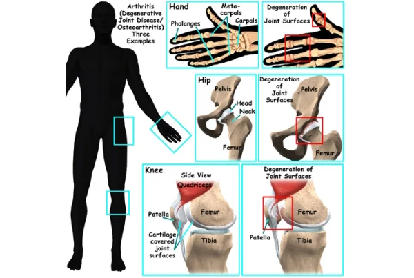 Osteoarthritis