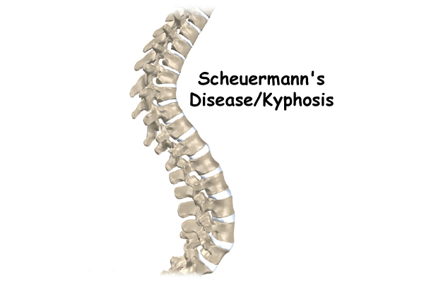 Scheuermann's Disease