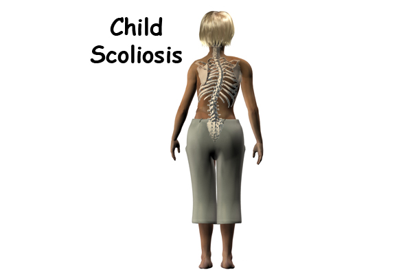 Scoliosis