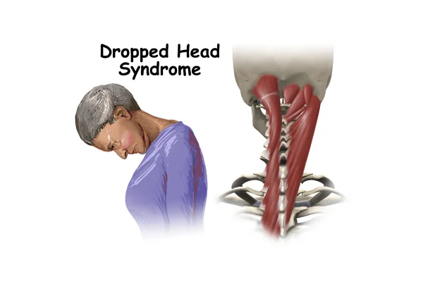 Dropped Head Syndrome