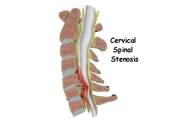 Cervical Spinal Stenosis