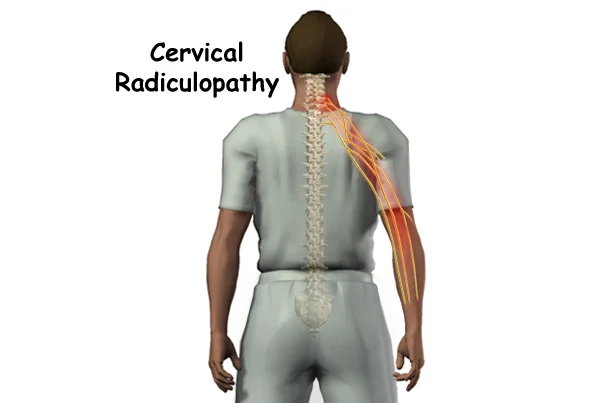 Cervical Radiculopathy