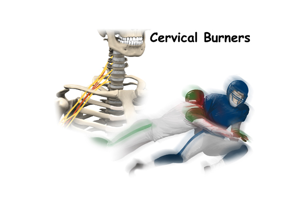 Cervical Burners and Stingers (Brachial Plexis Injuries)