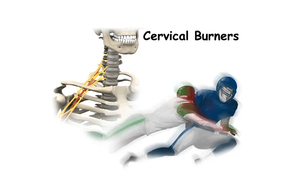 Cervical Burners and Stingers (Brachial Plexis Injuries)