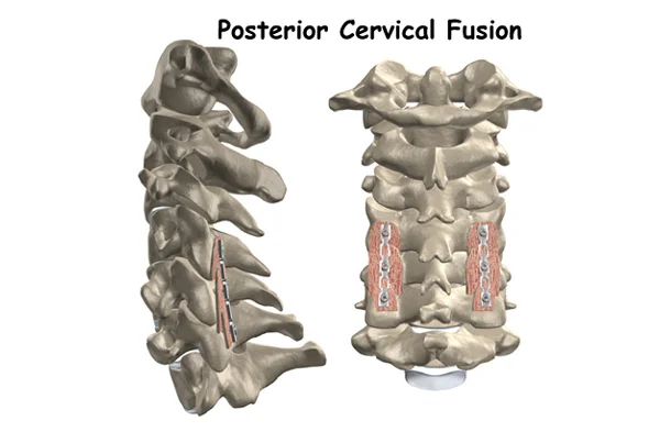 Posterior Cervical Fusion