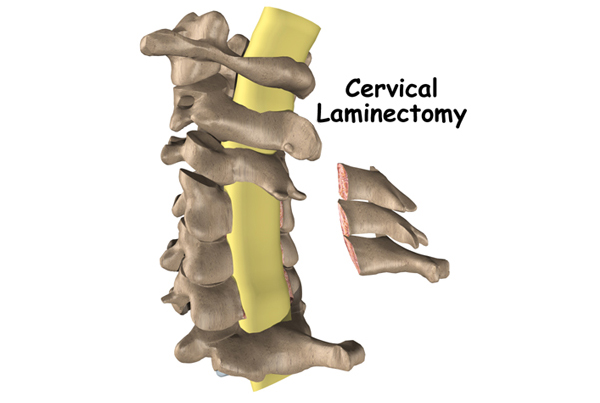 Cervical Laminectomy