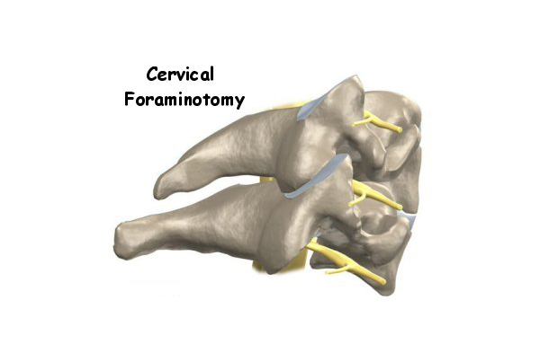 Cervical Foraminotomy