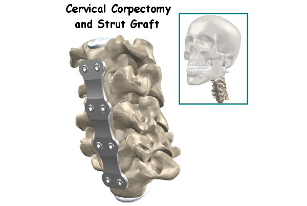 Cervical Corpectomy and Strut Graft