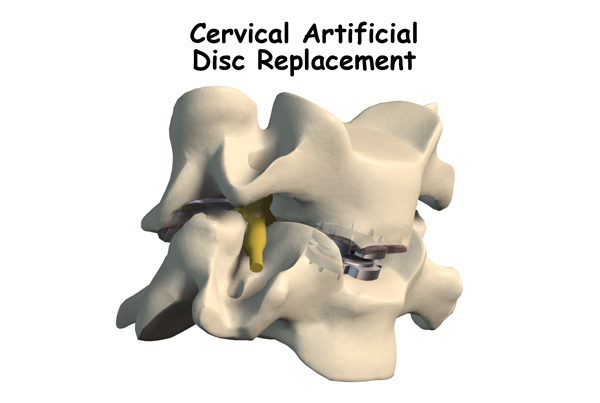 Cervical Artificial Disc Replacement