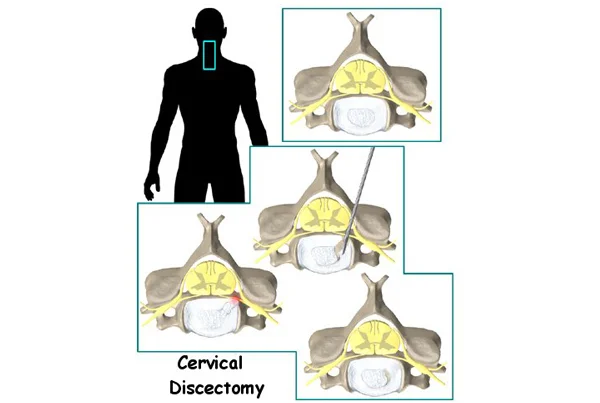 Upper Back and Neck