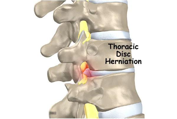 Thoracic Disc Herniation