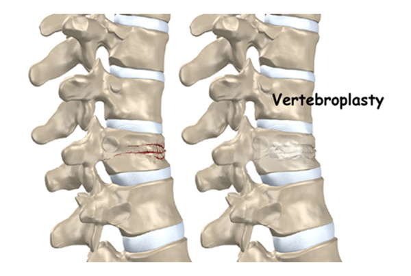 Vertebroplasty